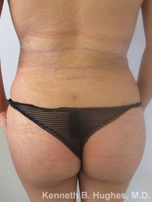 Liposuction Before & After Patient #9196