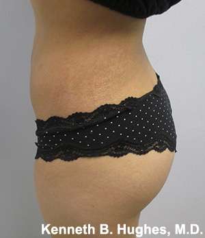 Liposuction Before & After Patient #9199