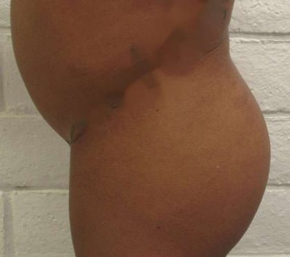 Liposuction Before & After Patient #9207