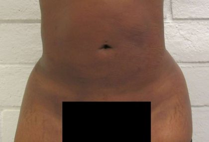 Liposuction Before & After Patient #9210