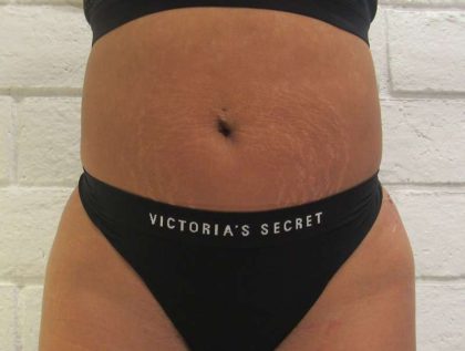 Liposuction Before & After Patient #9213