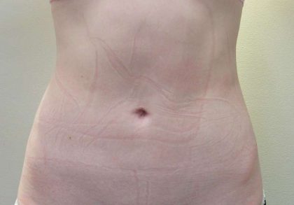 Liposuction Before & After Patient #9216