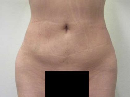 Liposuction Before & After Patient #9219