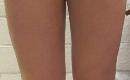 Liposuction Before & After Patient #9233