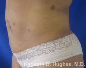 Liposuction Before & After Patient #9240