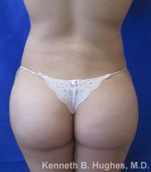 Liposuction Before & After Patient #9245