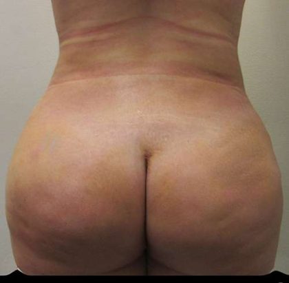 Brazilian Butt Lift Before & After Patient #6214