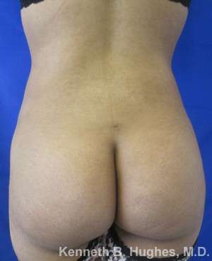 Liposuction Before & After Patient #9248
