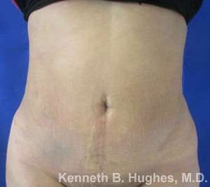 Liposuction Before & After Patient #9255