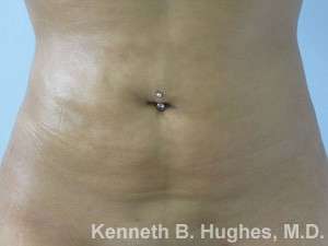 Liposuction Before & After Patient #9258