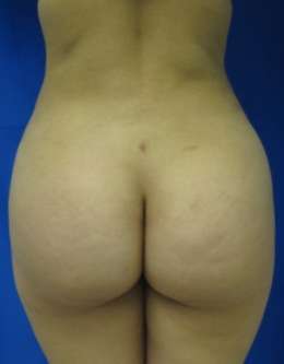Liposuction Before & After Patient #9264