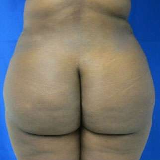 Liposuction Before & After Patient #9276