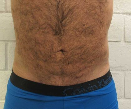 Brazilian Butt Lift Before & After Patient #6223