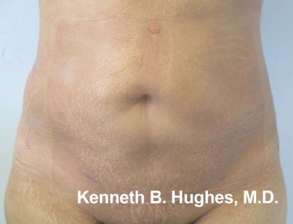 Liposuction Before & After Patient #9284