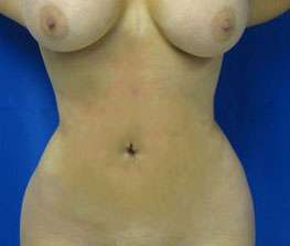 Liposuction Before & After Patient #9287