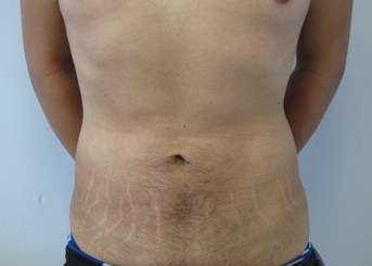 Liposuction Before & After Patient #9293