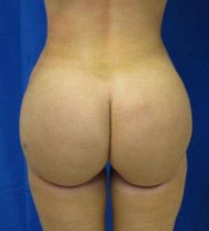 Liposuction Before & After Patient #9296