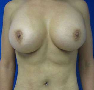 Liposuction Before & After Patient #9299