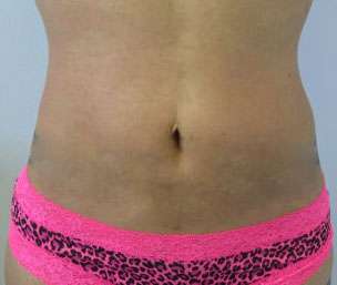 Liposuction Before & After Patient #9305