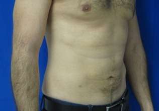 Liposuction Before & After Patient #9310