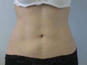 Liposuction Before & After Patient #9313