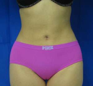 Liposuction Before & After Patient #9316