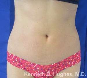 Liposuction Before & After Patient #9323