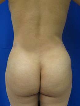 Liposuction Before & After Patient #9329