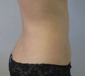 Liposuction Before & After Patient #9332