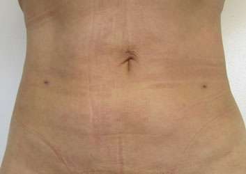 Liposuction Before & After Patient #9338