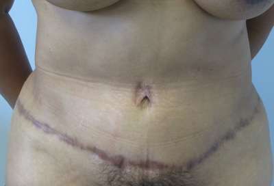 Liposuction Before & After Patient #9341