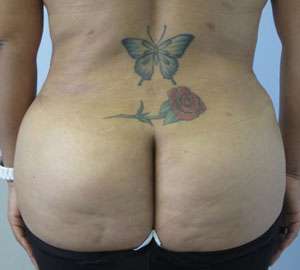 Liposuction Before & After Patient #9344