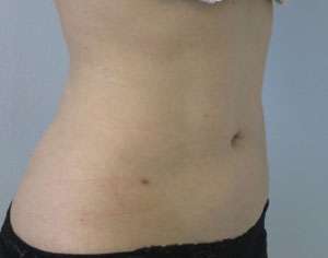 Liposuction Before & After Patient #9347