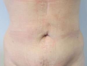 Liposuction Before & After Patient #9353