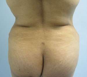 Liposuction Before & After Patient #9359
