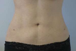 Liposuction Before & After Patient #9365