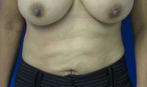 Liposuction Before & After Patient #9368