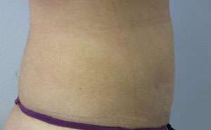Liposuction Before & After Patient #9371