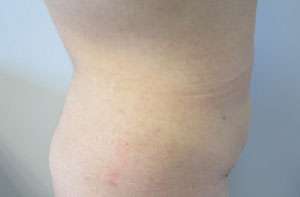 Liposuction Before & After Patient #9374