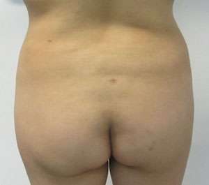 Liposuction Before & After Patient #9377