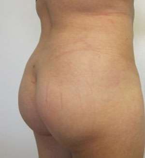 Liposuction Before & After Patient #9380