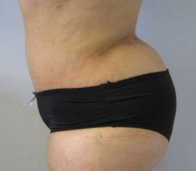 Liposuction Before & After Patient #9383