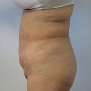 Liposuction Before & After Patient #9386