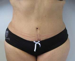 Liposuction Before & After Patient #9389