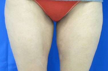Liposuction Before & After Patient #9392
