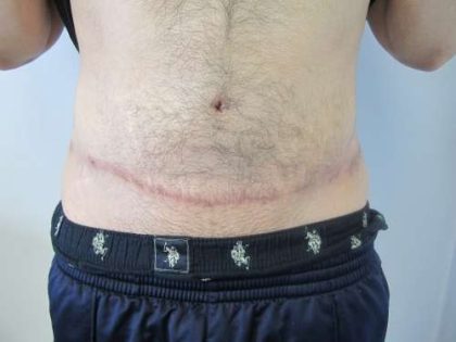 Liposuction Before & After Patient #9398