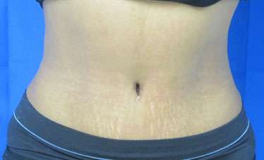Liposuction Before & After Patient #9401
