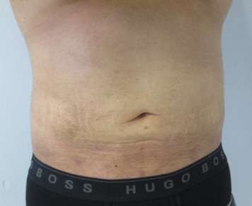 Liposuction Before & After Patient #9407