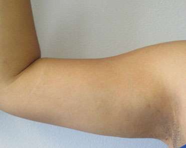 Liposuction Before & After Patient #9417