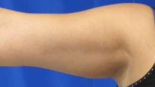Liposuction Before & After Patient #9422